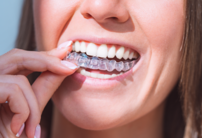 Close-up of a person inserting a clear dental aligner over their teeth, smiling. The image conveys a sense of oral hygiene and dental care.
