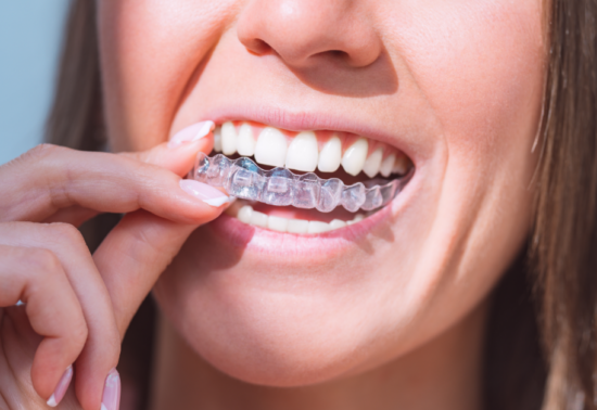 Close-up of a person inserting a clear dental aligner over their teeth, smiling. The image conveys a sense of oral hygiene and dental care.